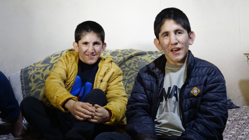 Çivrilli İkizler Hayatın Zorluklarına Birlikte Direniyor